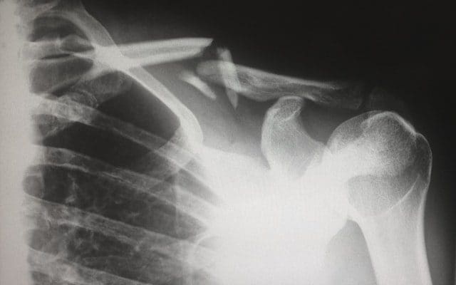 broken shoulder bone x-ray